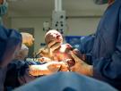 Nacer por cesárea puede afectar a la salud futura