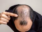 Cómo identificar los primeros síntomas de la alopecia