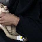 28 mayo 2012 Una mujer sostiene un niño desnutrido en sus brazos en el hospital de Saná (Yemen).