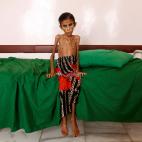 Febrero de 2019. La joven yemen&iacute; Fatima Ibrahim Hadi, de 12 a&ntilde;os y de apenas 10 kilos de peso, en una cl&iacute;nica de Aslam (Yemen).