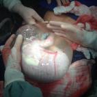 Bebé nacido con el saco amniótico sin romper: el parto que se hizo viral .