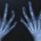 Las probabilidades de nacer con más de cinco dedos en las manos o en los pies son sólo de 1 de entre 500.