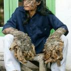 Pescador de Indonesia: Este hombre dejó atónitos a los médicos cuando verrugas comenzaron a crecerle en todo su cuerpo. Estas se asemejan a las raíces de un árbol. Agraciadamente éstas están siendo removidas gracias a la ayuda de un derma...