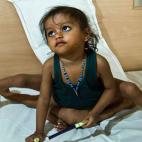 Lakshmi antes de su cirugía: La niña india, aquí con dos años de edad, nació con ocho extremidades. Su condición fue consecuencia de la fusión de su cuerpo con la de un gemelo que no se desarrolló. Lakshmi fue sometida a una cirugía que...
