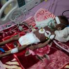 Rahmah Watheeq, una ni&ntilde;a malnutrida, es asistida en un hospital de Sanaa, Yemen, el 3 de noviembre.&nbsp;