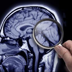Una investigación española apunta a los factores responsables del avance del Alzheimer