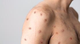 Estos son los casos de viruela del mono detectados en España en lo que va de 2024