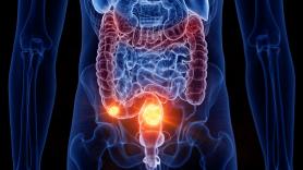 Le diagnostican cáncer de intestino a los 25 años y ahora advierte de las cuatro señales a tener en cuenta