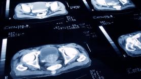 "Los hombres vienen cuando el cáncer está avanzado": un médico advierte de los primeros síntomas que suelen pasar desapercibidos