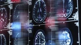 Las señales de Alzheimer que pueden aparecer hasta 18 años antes del diagnóstico