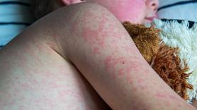 Repunte del virus de la 'bofetada' en niños: estos son los tres síntomas