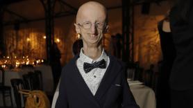 Muere a los 28 años el paciente de progeria más longevo del mundo