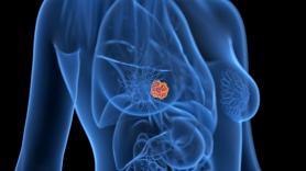 Los virus respiratorios pueden despertar y promover la metástasis pulmonar del cáncer de mama