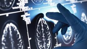 El litio podría explicar la enfermedad de Alzheimer (y también tratarlo)