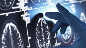 Los expertos alertan que el 'asesino silencioso' del cerebro es este simple alimento: cada español devora 29 kilos por año