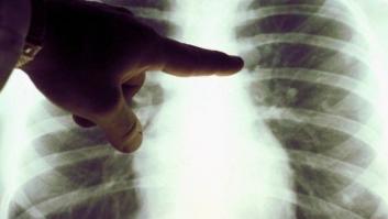 Científicos españoles prueban con éxito un fármaco contra el cáncer de pulmón