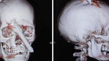 Un hombre sobrevive en Brasil después de que una barra de dos metros le perforase el cráneo