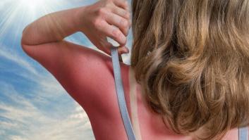 Esto es lo que le pasa a la piel después de sufrir una quemadura solar