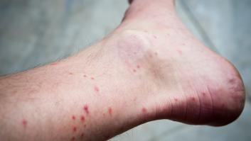 ¿Por qué los mosquitos se ceban con nuestros tobillos?