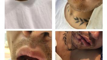 Un hombre, operado en Barcelona tras una brutal agresión homófoba que lo dejó sin dientes
