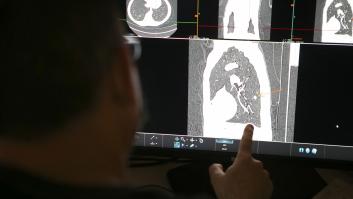 Investigadores españoles hallan el ‘talón de Aquiles’ del cáncer de pulmón