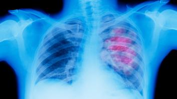 Un estudio español cambia el paradigma para tratar el cáncer de pulmón precoz