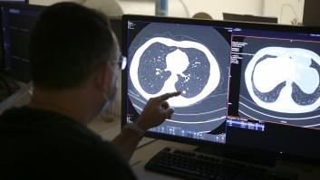 Un tratamiento probado en España multiplica por seis los cánceres de pulmón que desaparecen totalmente