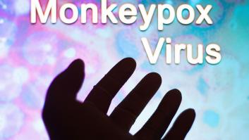 Aumentan a 75 los casos de viruela del mono en la Comunidad de Madrid