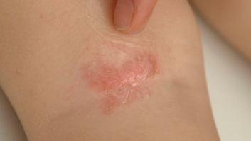 Dermatitis atópica: 11 preguntas (y respuestas) sobre esta enfermedad frecuente