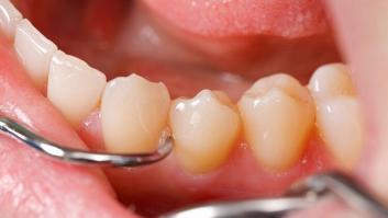 Qué es y cómo tratar la periodontitis, la enfermedad que dispara el riesgo de muerte por coronavirus