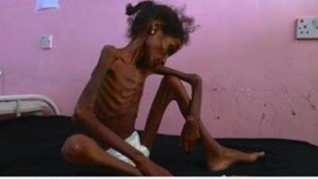 Facebook censura una foto del 'NYT' de la hambruna en Yemen por mostrar "desnudez" y "contenido sexual"