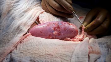 Trasplantan por primera vez el riñón de un cerdo a un humano