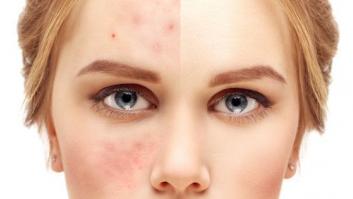¿Es una simple luz el remedio definitivo contra el acné?