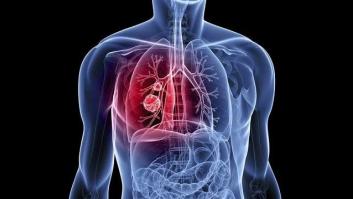 ¿Una muestra de ADN de la nariz podrá diagnosticar el cáncer de pulmón?