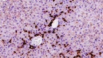 Las células del hígado reclutan células madre para desarrollar cáncer