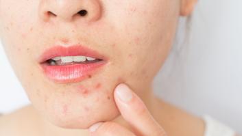 Esta es la causa de tu acné, según la zona de la cara donde aparece