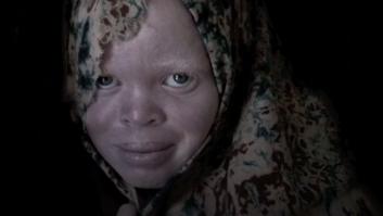 La española que ayuda a vencer al gran enemigo de los albinos en África