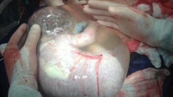 Bebé nacido con el saco amniótico sin romper: un parto se hace viral (FOTO)