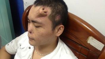 Médicos chinos crean una nariz en la frente de un joven