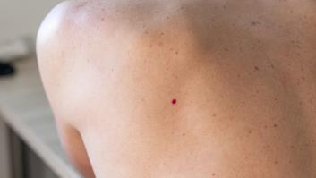 Por qué salen los puntos rojos en la piel y cuándo es necesario ir al médico