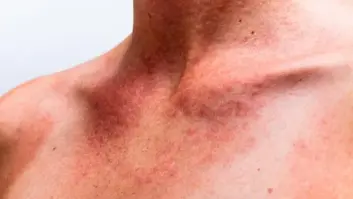 Sarpullido por calor: qué es, quién es más sensible a la dermatitis y cómo tratar el picor