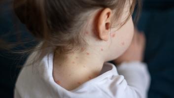 Sanidad espera brotes de sarampión en España, pero insiste en el bajo riesgo de contagio