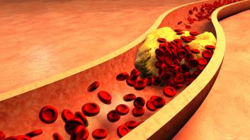 Un estudio aporta evidencias sobre el papel del LDL y HDL en enfermedades cardiovasculares como el ictus isquémico