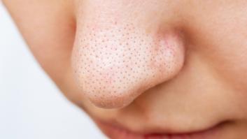 La mascarilla casera con dos ingredientes de lo más sorprendentes que promete extraer los puntos negros "como una aspiradora"