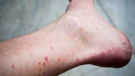Numerous mosquito bites on a man's lower leg and ankle