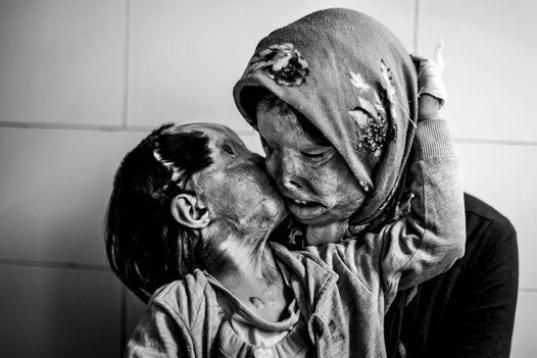 Una madre y su hija de 3 años. Fueron atacadas con ácido por el padre de familia. 