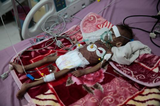 Rahmah Watheeq, una niña malnutrida, es asistida en un hospital de Sanaa, Yemen, el 3 de noviembre. 