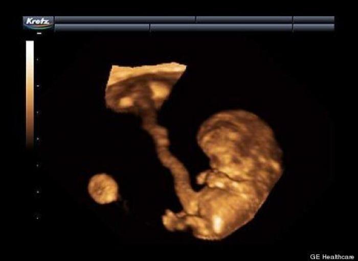 Vídeo del primer año de un bebé prematuro