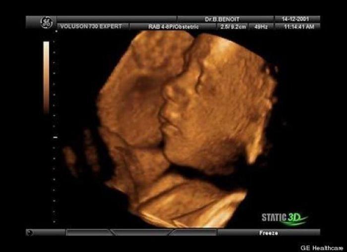 Vídeo del primer año de un bebé prematuro