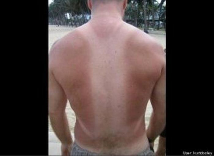 Quemaduras en la playa: 'tatuajes solares' que te pueden dejar los graciosos de tus amigos (FOTOS)